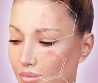 Melasma si tratamentul leziunilor pigmentare la DermaLife